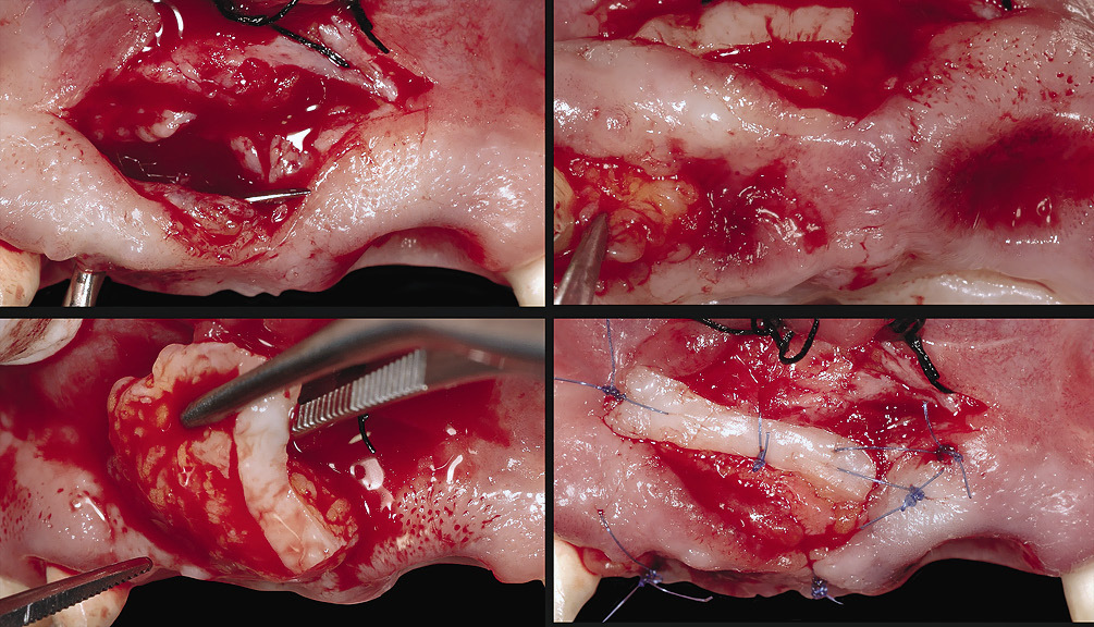 Рис. 5 а — г. Соединительнотканный трансплантат был установлен с использованием туннельного подхода после проведения френектомии.