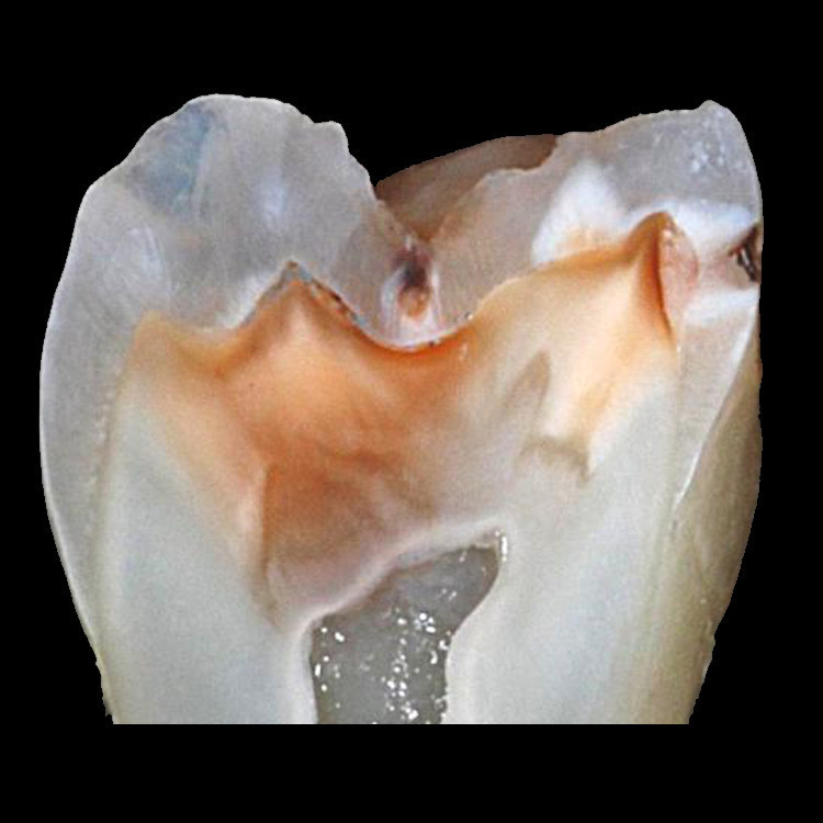 Рис. 1. Значительный объем размягченного дентина при минимальном повреждении эмали.