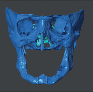 Рис. 3б. Пациент с крайней верхнечелюстной атрофией; скелетная реконструкция 3D.