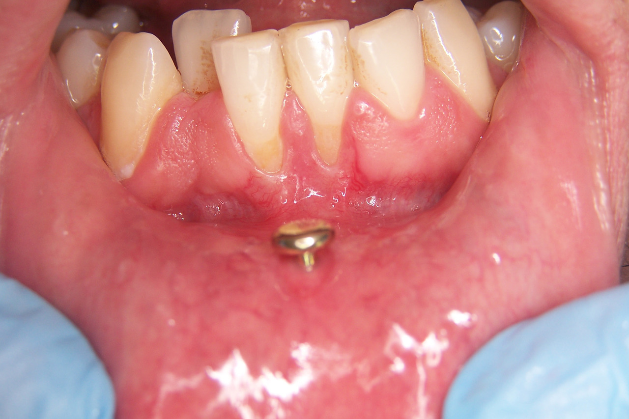 Рис. 2. Локальные рецессии десны (второго класса по Миллеру) зубов 31, 41, ассоциированные с длительным ношением пирсинга нижней губы.