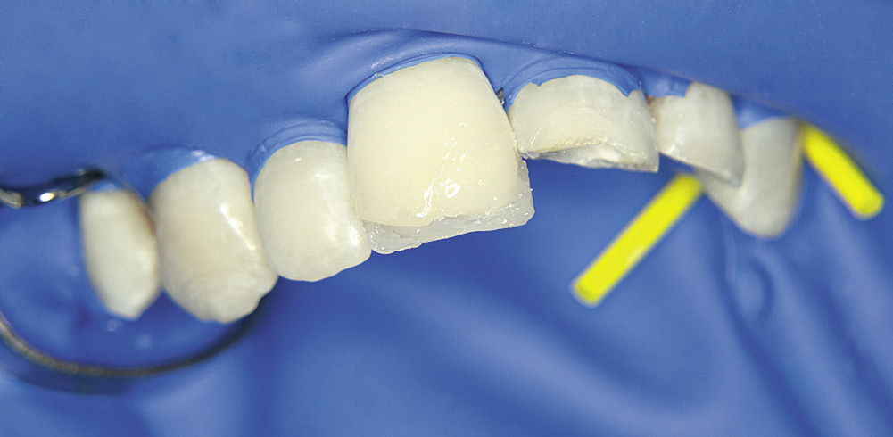 Рис. 5. Зуб 1.1 — восстановление дентина опаковым оттенком.
