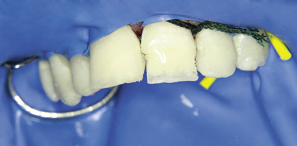 Рис 7. Зубы 2.1 и 2.2 — этап реставрации.