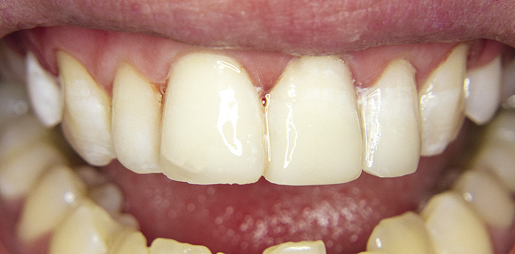 Рис. 8. Зубы 1.1, 2.1, 2.2 — окончательный вид реставраций.