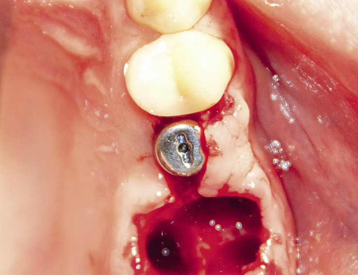 Рис. 41. Лунка 16 зуба. Формирователь десны на имплантате на месте 15 зуба.
