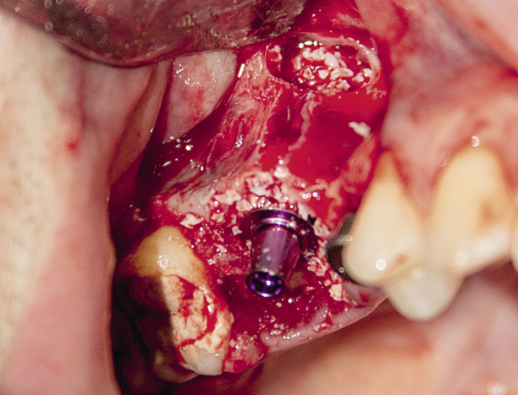 Рис. 43. Установлен имплантат, альвеолы заполнены ксенотрансплантатом Bio-Oss в смеси с аутокостной стружкой.