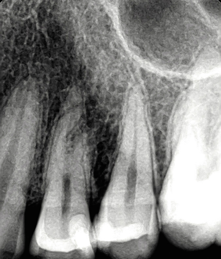 Рис. 1. По данным рентгенографии определяется возможное сообщение кариозной полости с полостью зуба 24.