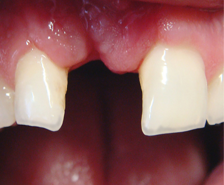 Рис. 1. Исходная клиническая ситуация: включенный дефект зубного ряда.