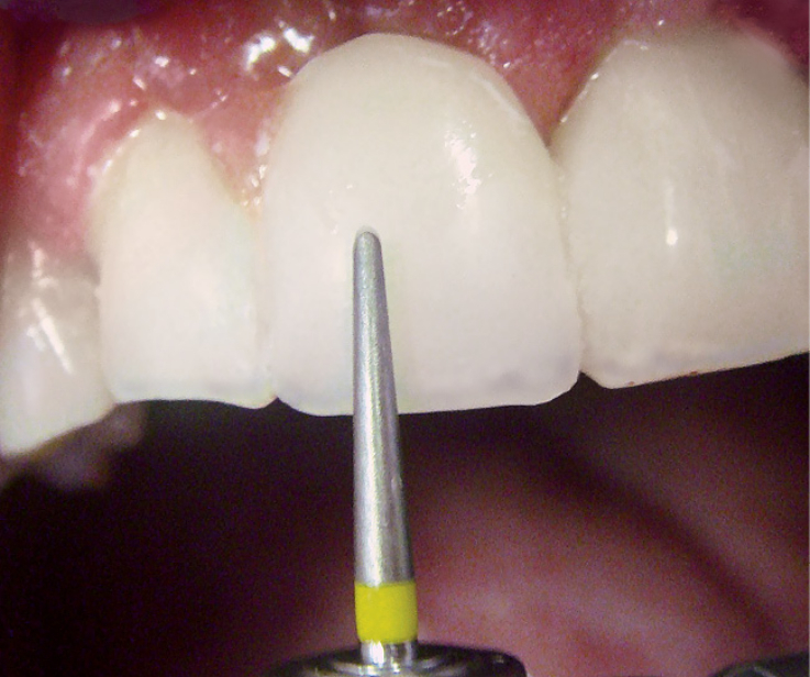 Рис. 16. Контурирование мелкозернистым алмазным бором вестибулярной поверхности 11 зуба.