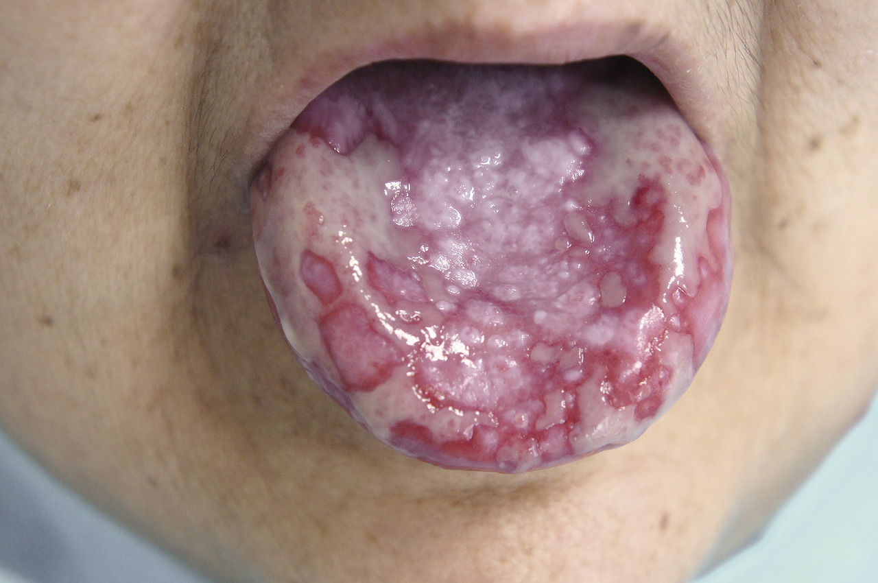 Рис. 1. Дорсальная поверхность языка при красном плоском лишае. Сочетание гиперкератотической, эрозивно-язвенной и экссудативно-гиперемической форм (до лечения).