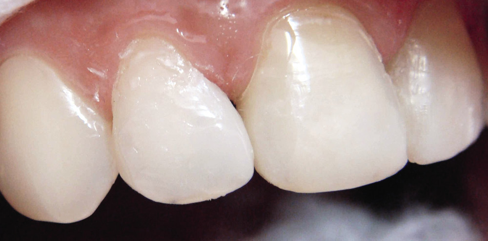 Рис. 22а. При пломбировании латеральных резцов изменяют их размеры и положение в зубной дуге: реставрация правого резца.