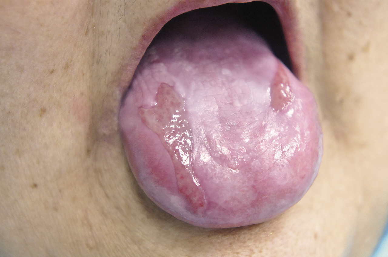 Рис. 2 Дорсальная поверхность языка при красном плоском лишае (по окончании лечения).