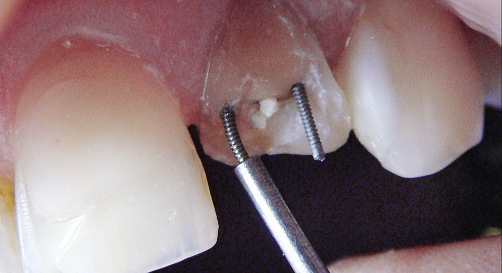 Рис. 5. Парапульпарные штифты в 22 зубе изогнуты с учетом анатомических особенностей резца.