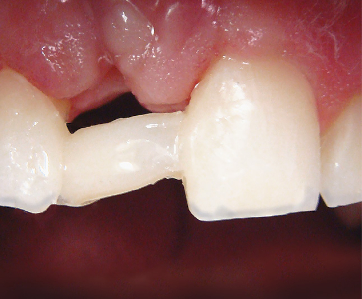 Рис. 7. Адаптированная на зубах лента покрыта опаковым слоем композитного материала.