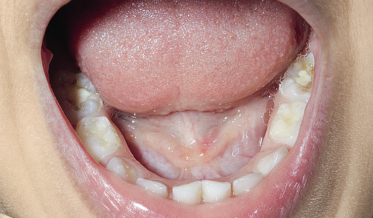 Рис. 9. Полость рта пациента с кариозными полостями на молярах.