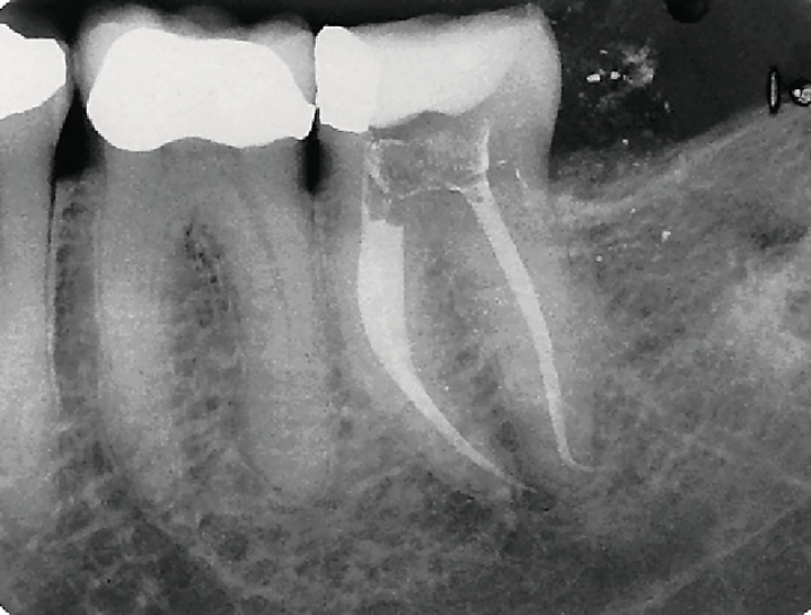 Рис. 4. Зуб 37, рентгенограмма, демонстрирующая резкую апикальную кривизну.
