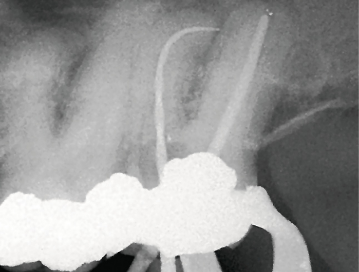 Рис. 5а. Зуб 27, рентгенограмма, демонстрирующая плавную апикальную кривизну.