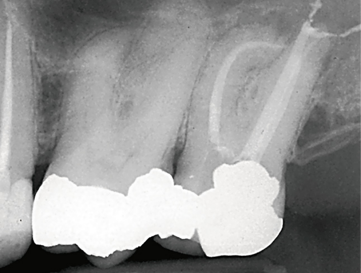 Рис. 5б. Зуб 27, рентгенограмма, демонстрирующая плавную апикальную кривизну.