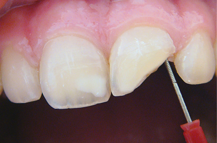 Рис. 3. Дистально в придесневой области зуба устанавливается Pin.