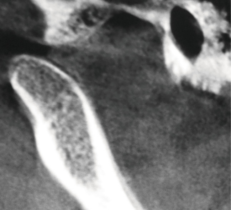 Рис. 2а. Определяется смещение головки нижней челюсти за пределы суставного бугорка. Диск располагается между суставным бугорком и задней поверхностью головки нижней челюсти.