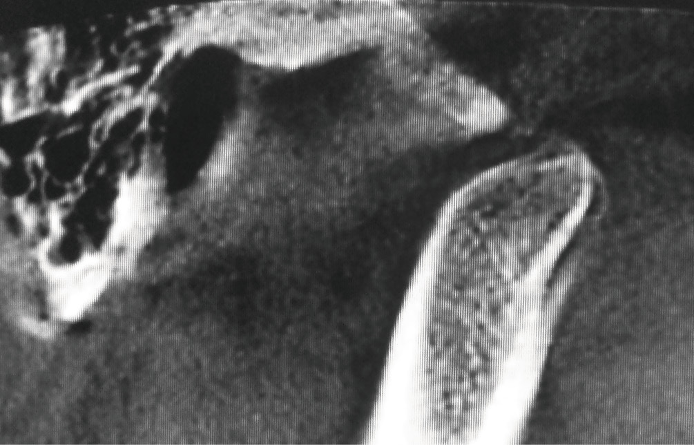 Рис. 3а. Правая головка нижней челюсти смещена за передний скат суставного бугорка. Диск располагается между задней поверхностью головки и суставным бугорком.