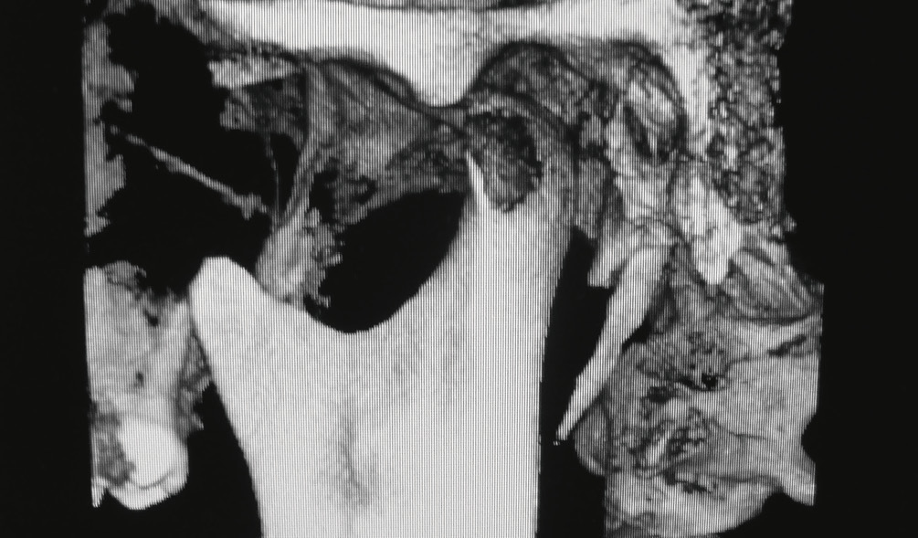 Рис. 4. При открытом рте левая головка нижней челюсти несколько смещается вперед, но остается на заднем скате суставного бугорка. Диск разобщает эти анатомические образования.