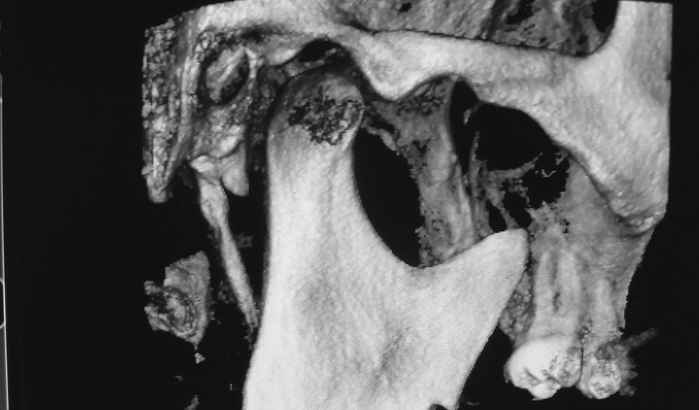 Рис. 5. При открытом рте правая головка смещается вперед, но остается на заднем скате суставного бугорка. Диск располагается между головкой и задним скатом суставного бугорка.