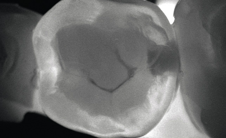 Рис. 2. Сохраненное изображение просвеченного зуба, полученное при обследовании с помощью KaVo DIAGNOcam.
