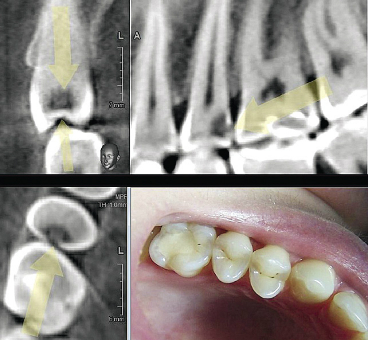 Рис. 8. Трехмерная визуализация кариозного процесса на дистальной поверхности зуба 15.