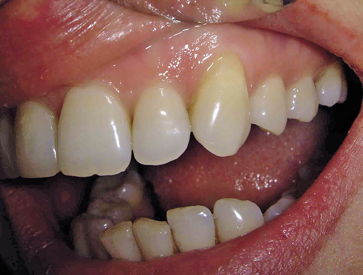 Рис. 1. Особенности оттенков цвета постоянных зубов.