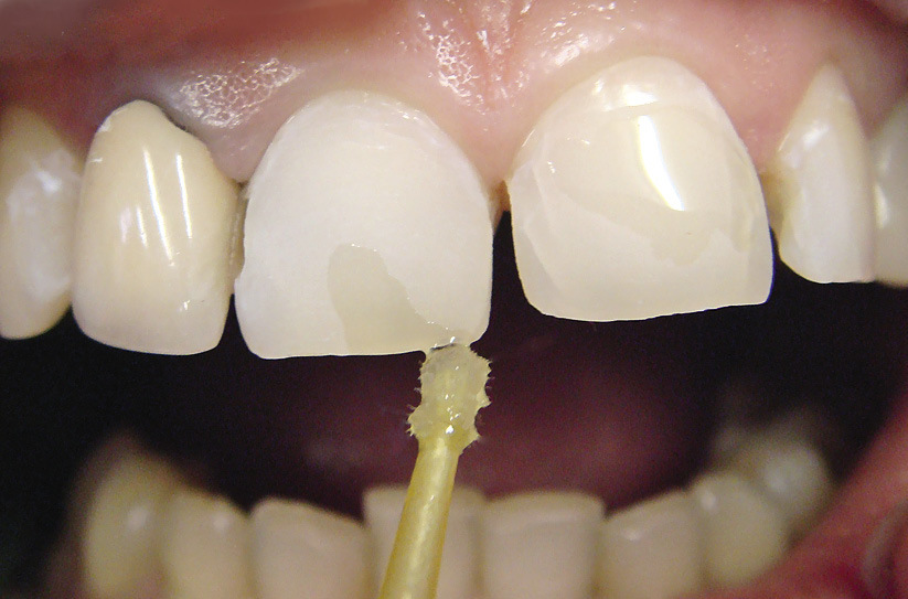 Рис. 6. Адгезивная подготовка твердых тканей зубов.