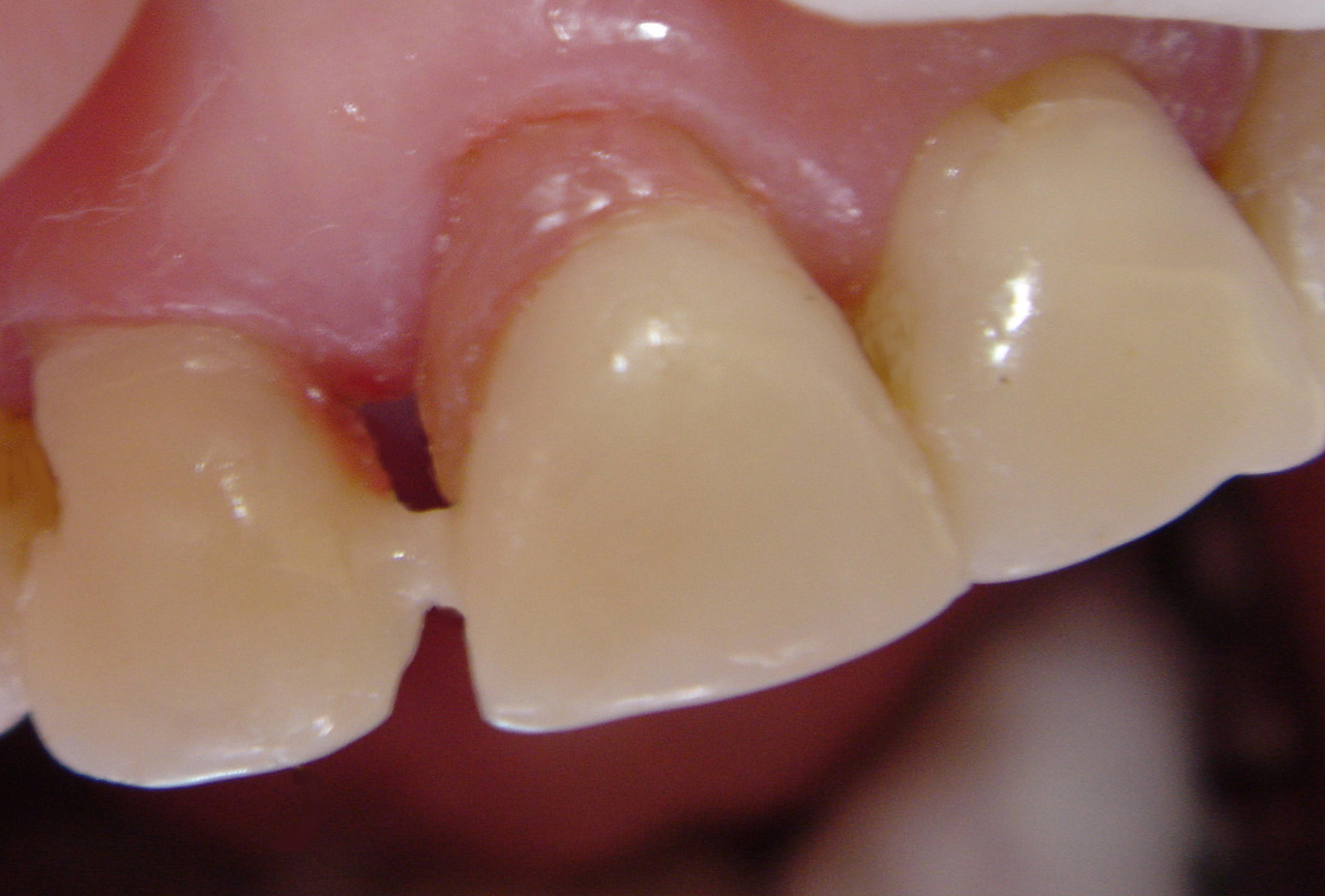 Рис. 4а. Корень зуба покрыт розовым фотополимером.