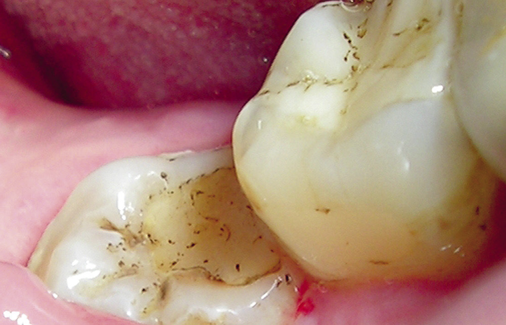 Рис. 17. Первоначальная клиническая ситуация: отрыв пломбировочного материала от тканей зуба.