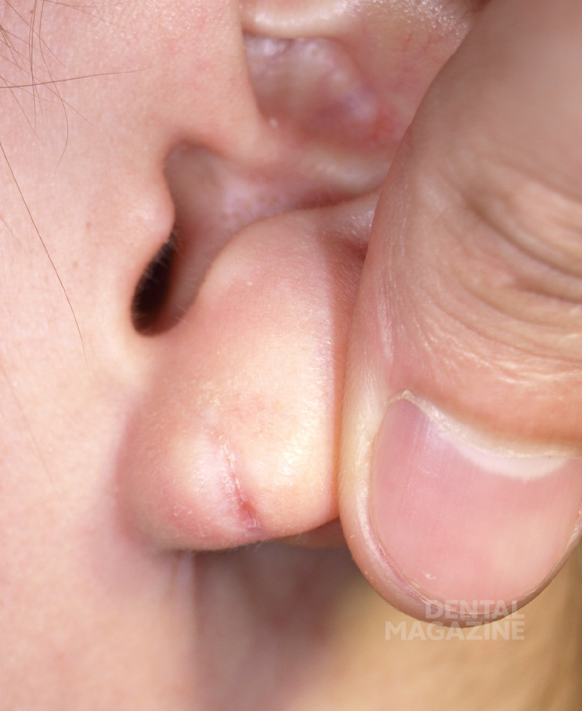 Рис. 1. Пациентка с тупым рассечением мочки уха.