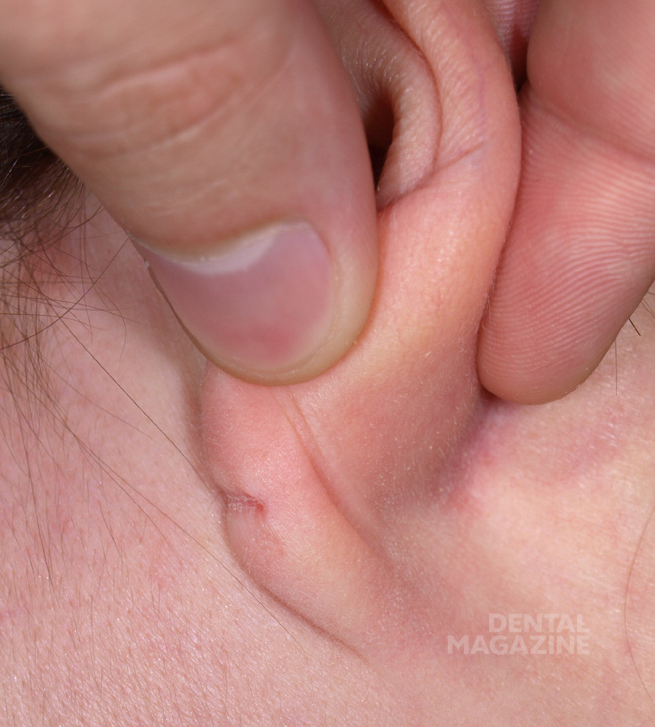 Рис. 2. Пациентка с тупым рассечением мочки уха.