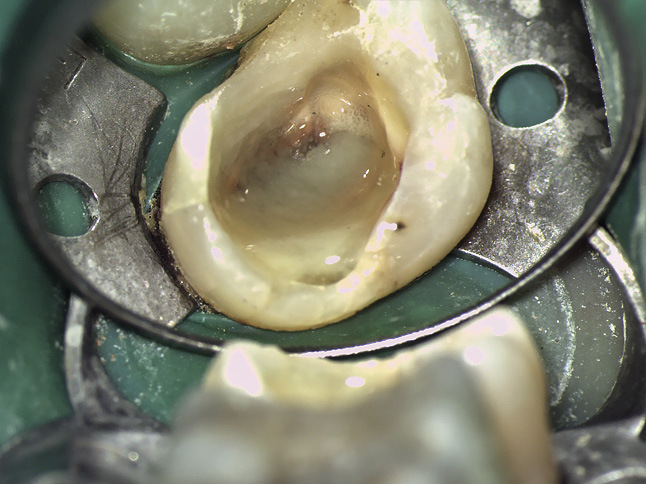 Рис. 3. 1-е посещение. Выделения из гайморовой пазухи. Снимок сделан с помощью микроскопа.