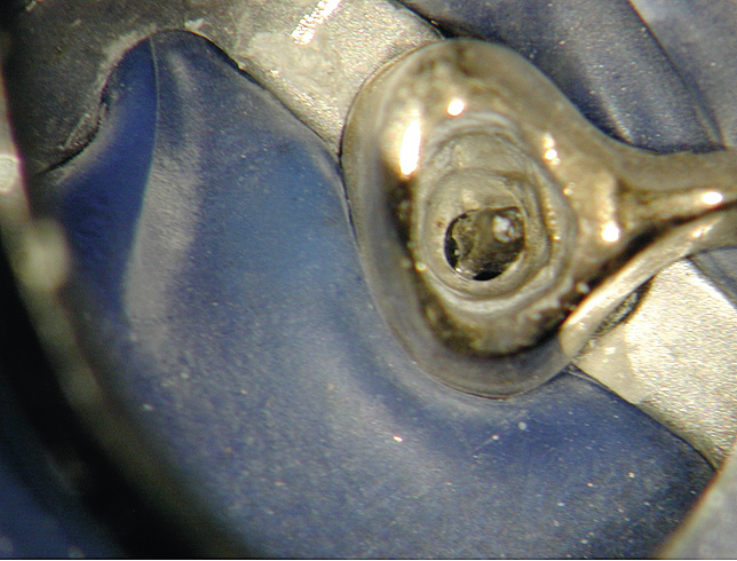 Рис. 3. 15 зуб после снятия коронки. Обширная восстановительная пломба, фиксированная при помощи анкерного штифта системы «Радикс-Анкер».
