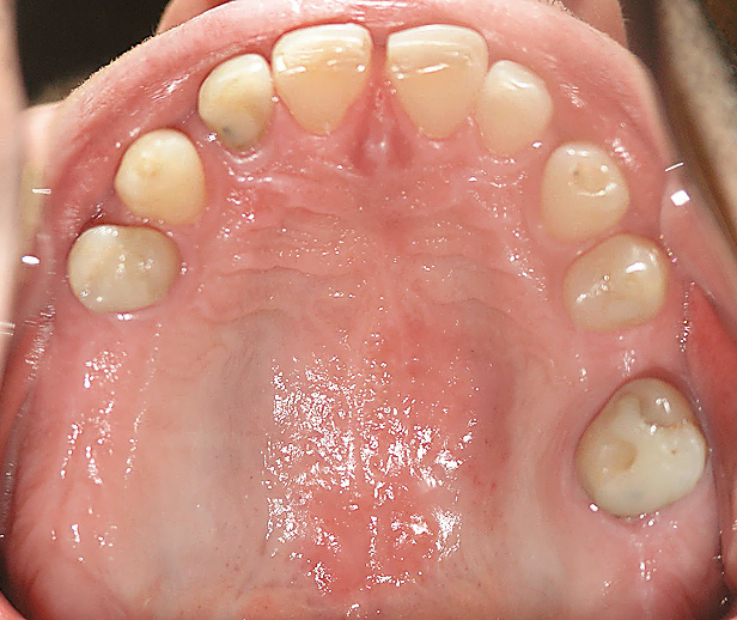 Рис. 3. Вид окклюзионной поверхности зубов верхней челюсти перед началом лечения.