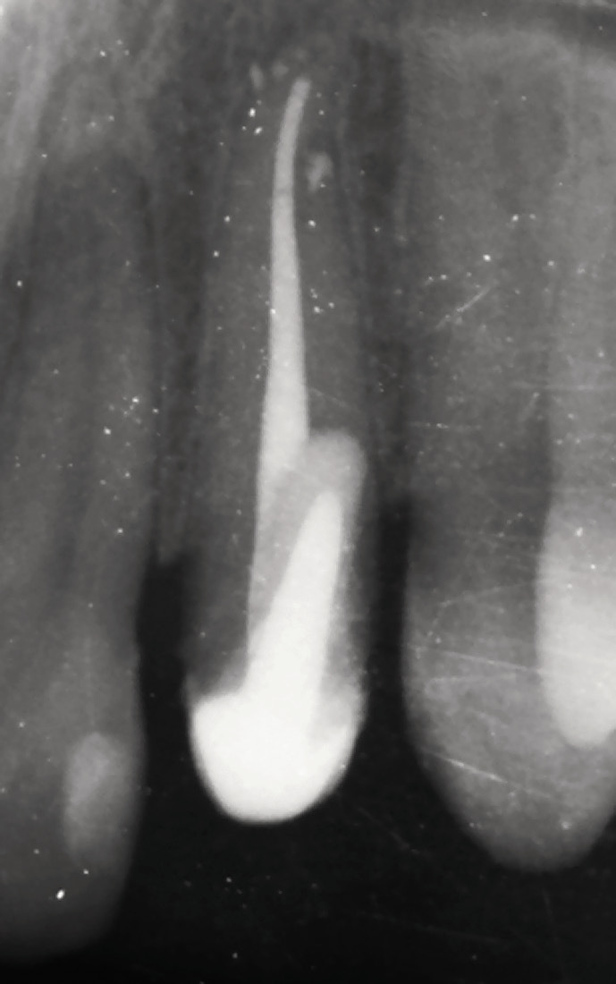 Рис. 3. Рентгенограмма зуба 22. Культевая штифтовая вкладка.