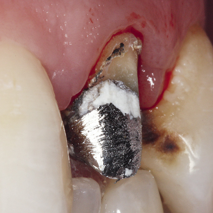 Рис. 4. Вид культи зуба после удаления искусственной коронки. Воспаление тканей маргинального пародонта.
