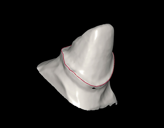 Рис. 11. Вид отсканированной культи зуба 22. Определение границы препарирования.