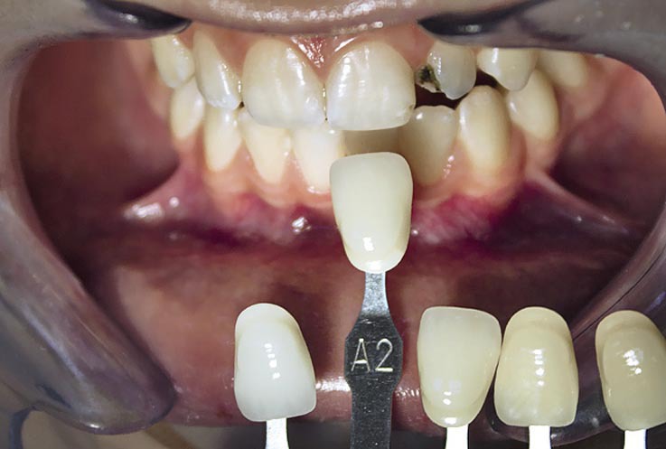 Рис. 4. Определение цветового тона зубов с использованием шкалы VITAPAN® Classical. 