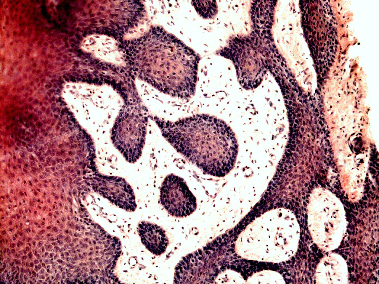 Рис. 3. Окрашивание гематоксилином и эозином: эпителиальный пласт и подлежащие соединительные ткани, участки клеток с вакуолизированной и слабоокрашенной цитоплазмой.