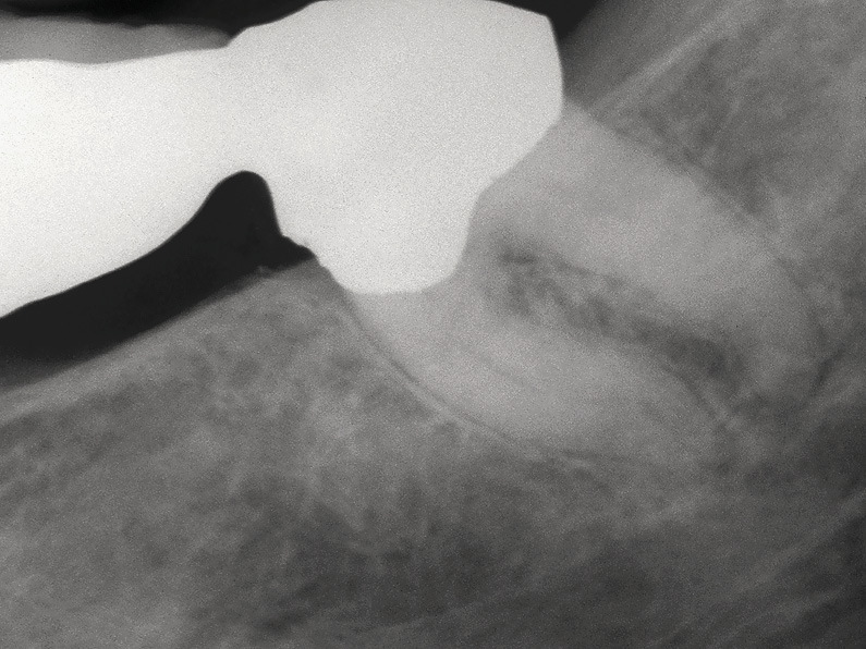 Рис. 2. Зуб, являющийся опорой мостовидного протеза в боковом отделе и нуждающийся в эндодонтическом лечении. Обратите внимание на ориентацию протеза относительно корней.
