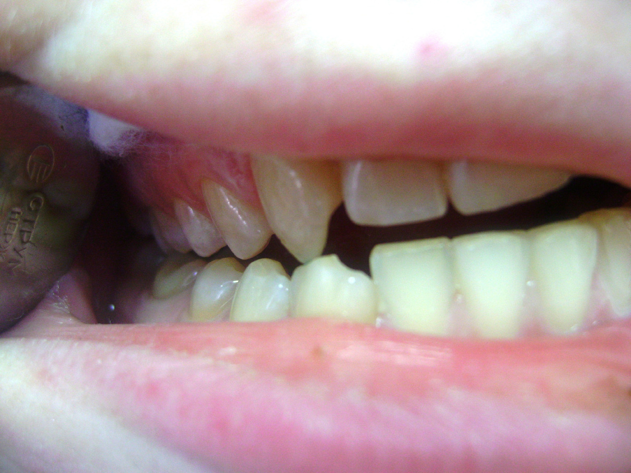 Рис. 5б. Смыкание зубных рядов: правая латеротрузия после лечения.