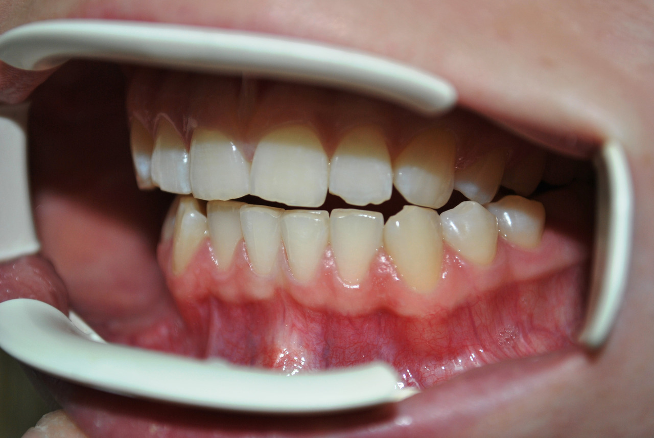 Рис. 5в. Смыкание зубных рядов: левая латеротрузия до лечения, левая латеротрузия после лечения.