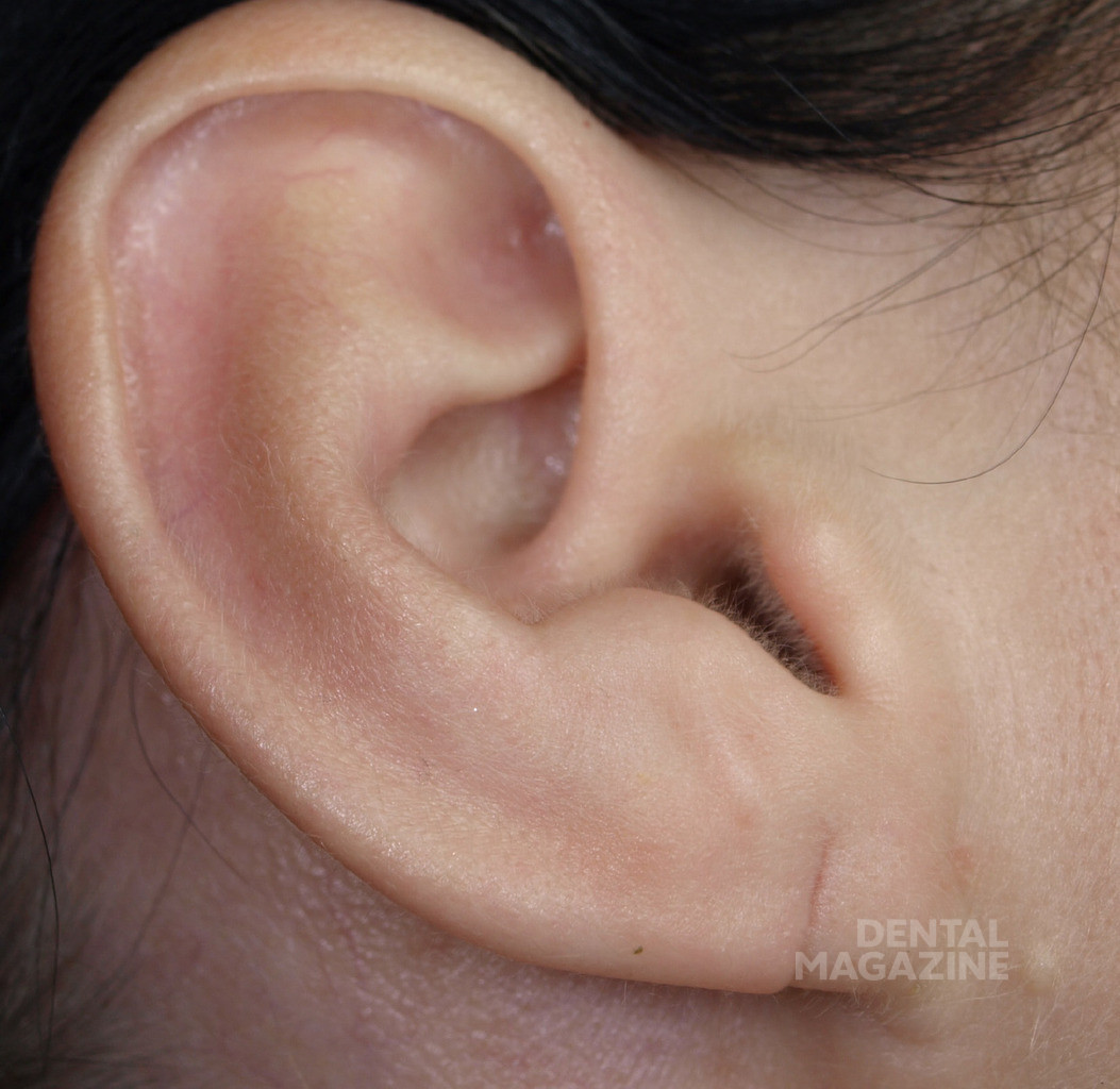 Рис. 9. Пациентка с тупым рассечением мочки уха.