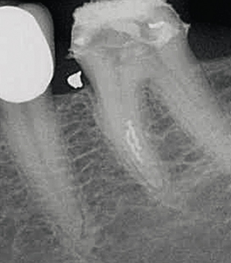 Рис. 1. Исходная прицельная рентгенограмма в области 46 зуба. Фрагменты обломанных эндодонтических инструментов.