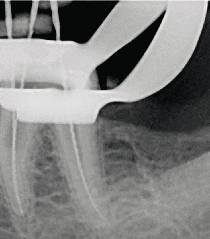 Рис. 5. Прицельная рентгенограмма. Рабочая длина корневых каналов с введенными эндодонтическими инструментами.