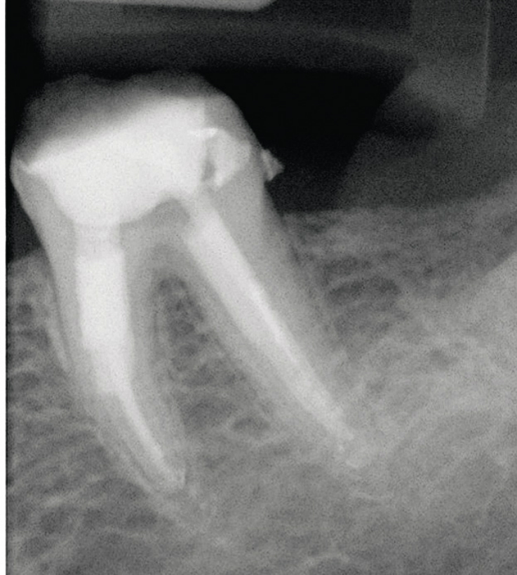 Рис. 6. Контрольная прицельная рентгенограмма в области 46 зуба.