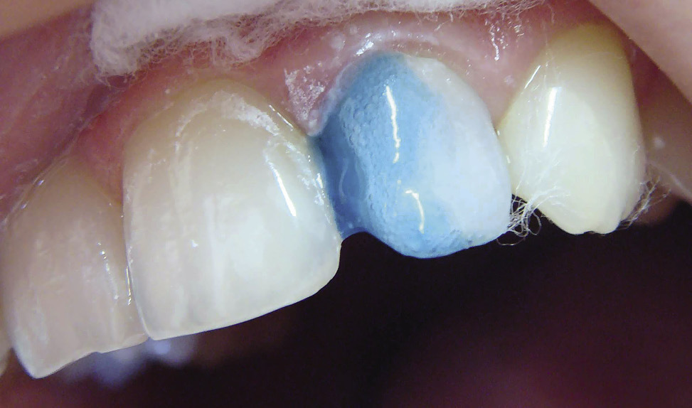 Рис. 4. С мезиальной поверхности 22 зуба удалена старая пломба, после препарирования твердых тканей нанесен травильный гель.